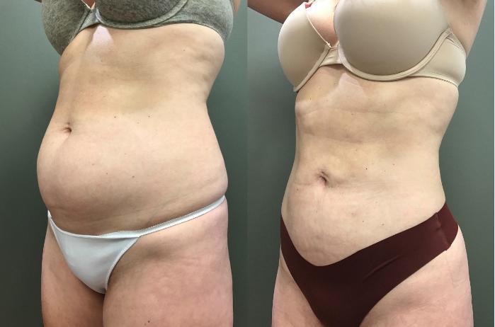 Before & After Liposuction Case 400 Left Oblique View in Ann Arbor, MI