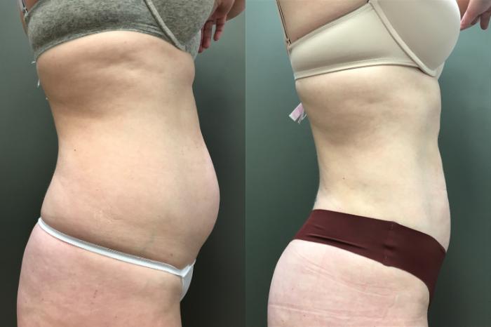 Before & After Liposuction Case 400 Right Side View in Ann Arbor, MI