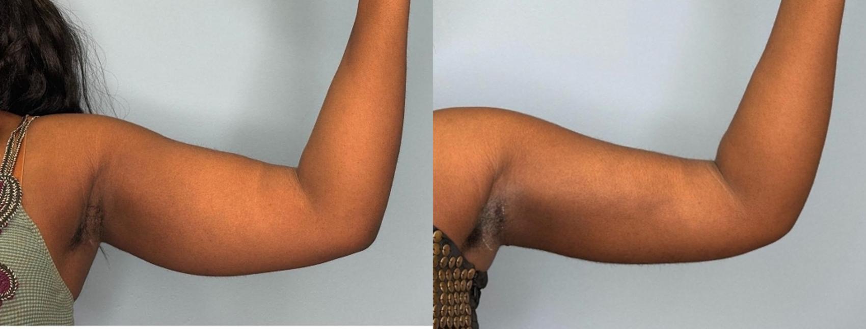 Before & After Liposuction Case 443 Left Side View in Ann Arbor, MI