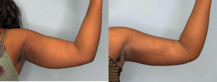 Before & After Arm Surgery Case 443 Left Side View in Ann Arbor, MI