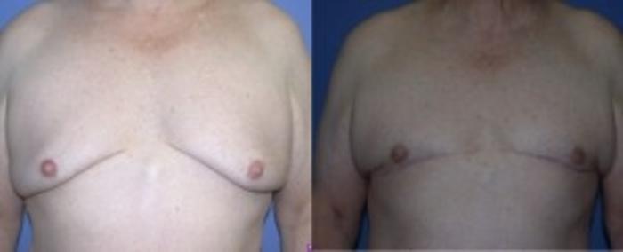 Before & After Male Breast Reduction Case 81 Front View in Ann Arbor, MI