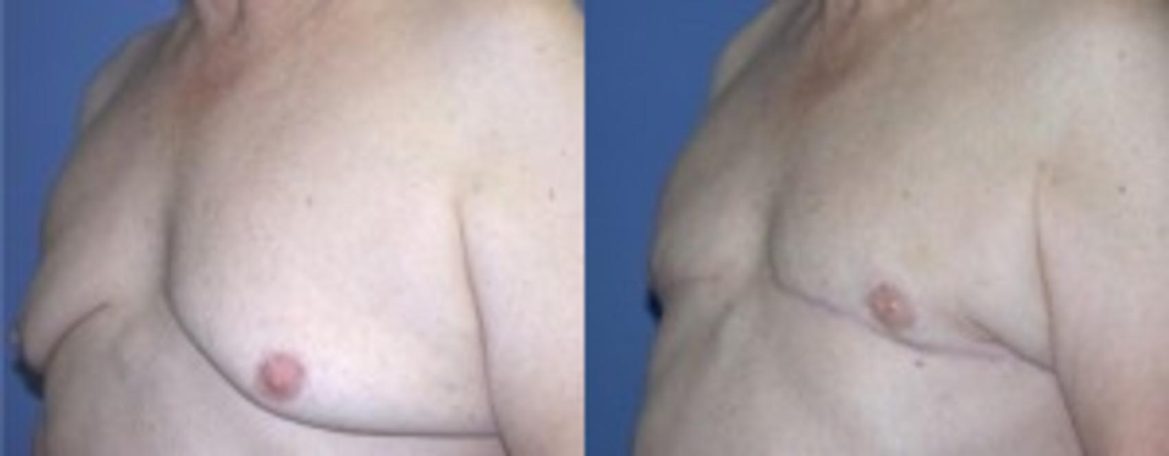 Before & After Male Breast Reduction Case 81 Left Oblique View in Ann Arbor, MI