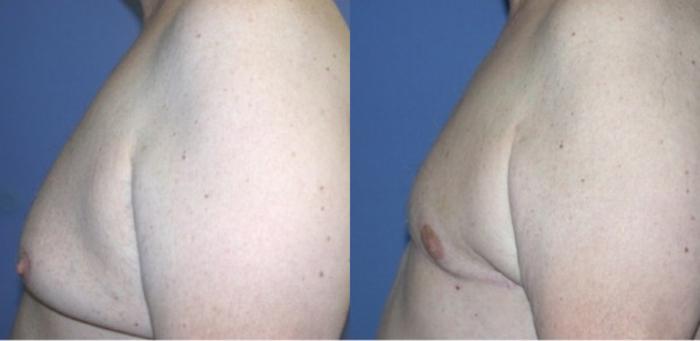 Before & After Male Breast Reduction Case 81 Left Side View in Ypsilanti, MI