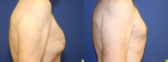 Before & After Male Breast Reduction Case 82 Right Side View in Ann Arbor, MI
