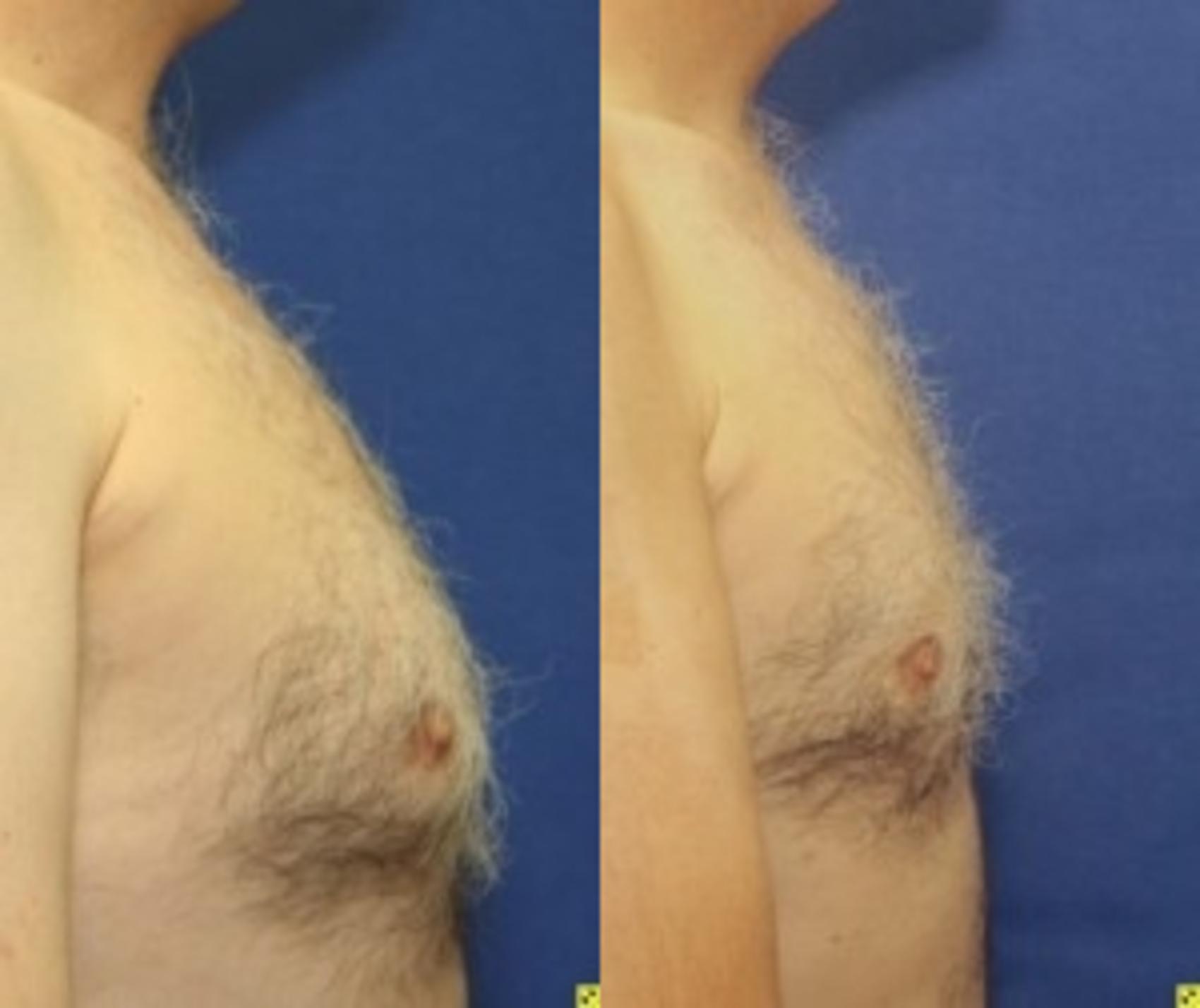 Before & After Male Breast Reduction Case 83 Right Side View in Ypsilanti, MI