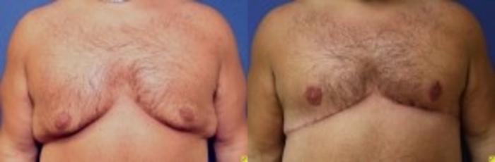 Before & After Male Breast Reduction Case 84 Front View in Ypsilanti, MI