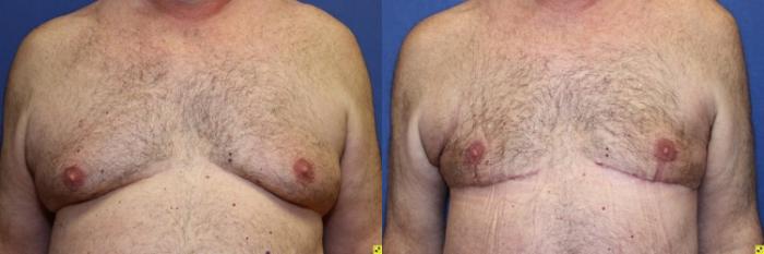 Before & After Male Breast Reduction Case 85 Front View in Ypsilanti, MI