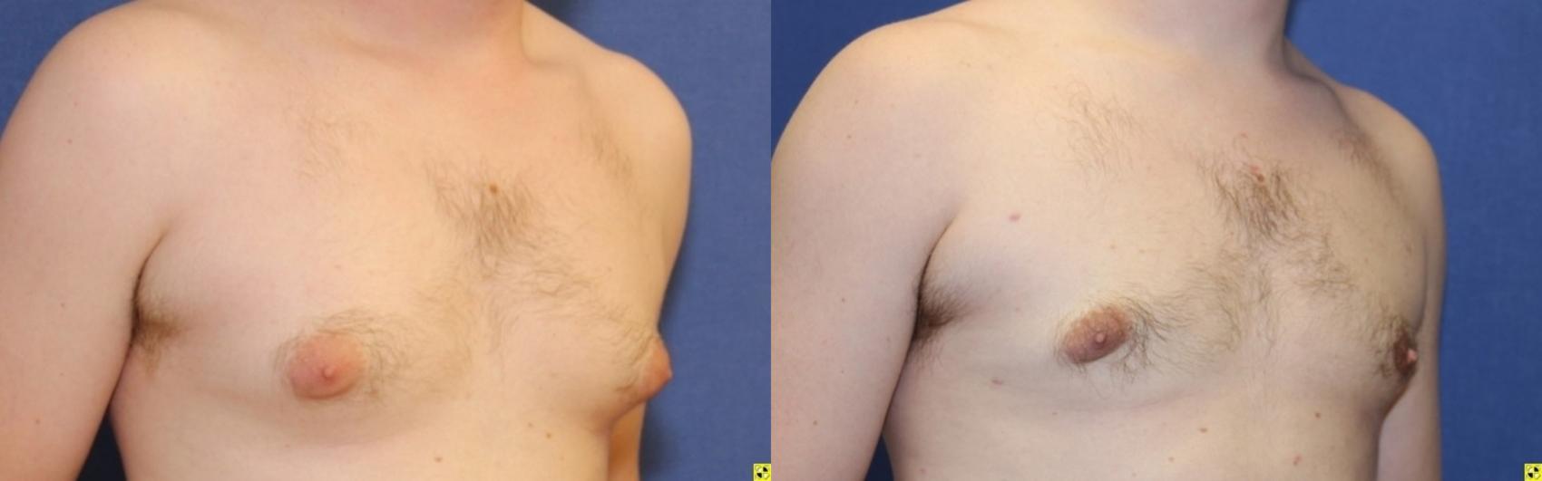 Before & After Male Breast Reduction Case 86 Right Oblique View in Ann Arbor, MI