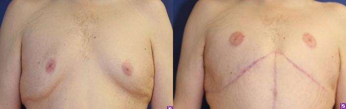 Before & After Male Breast Reduction Case 87 Front View in Ann Arbor, MI