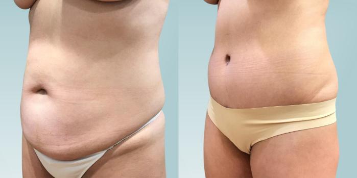 Before & After Tummy Tuck Case 404 Left Side View in Ann Arbor, MI