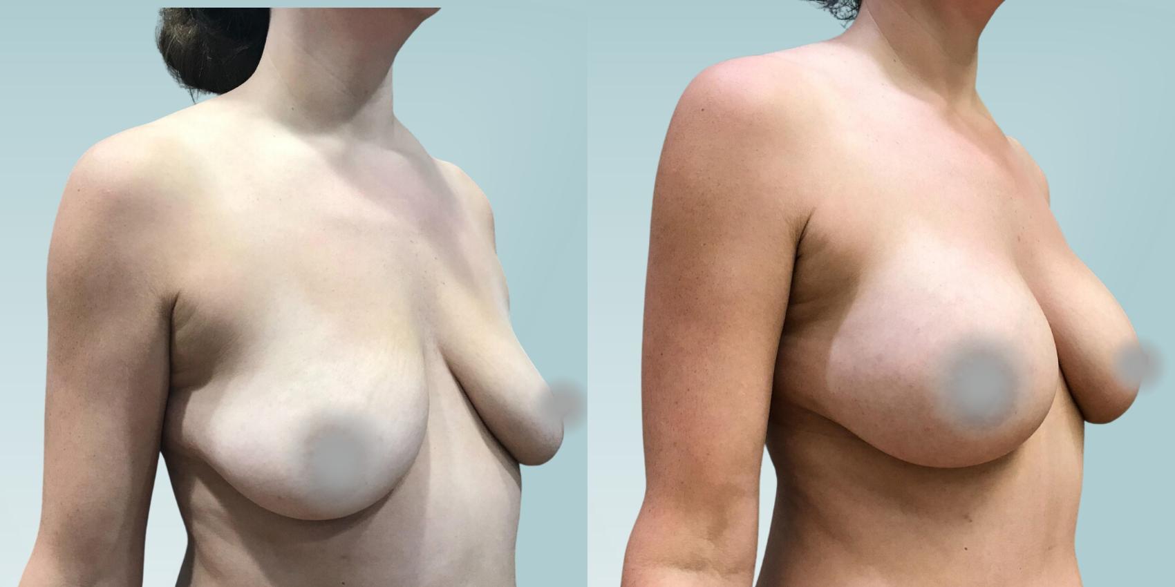 Before & After Tummy Tuck Case 404 Right Side View in Ann Arbor, MI