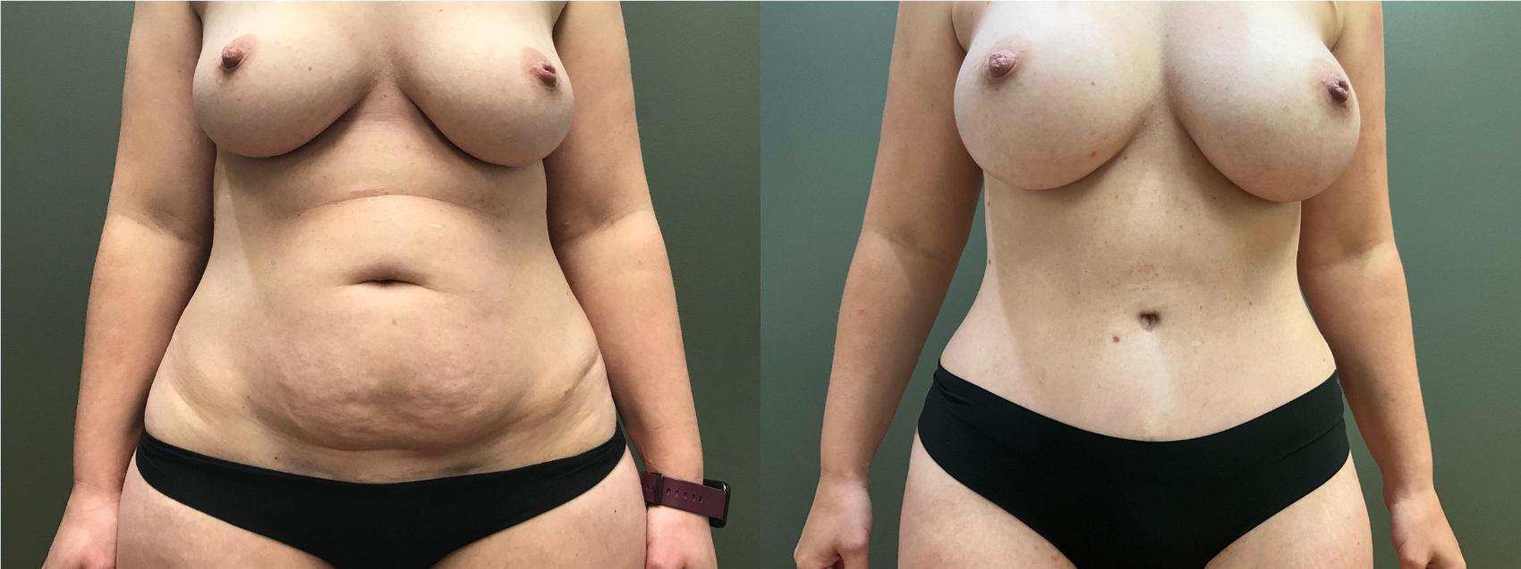 Before & After Tummy Tuck Case 405 Front View in Ann Arbor, MI