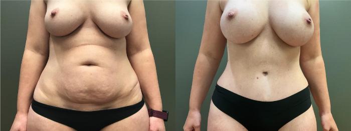 Before & After Breast Augmentation Case 405 Front View in Ann Arbor, MI