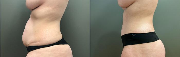 Before & After Breast Augmentation Case 405 Left Side View in Ann Arbor, MI