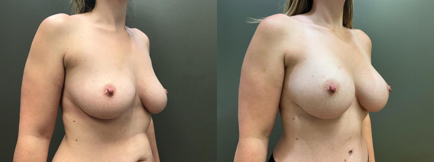 Before & After Mommy Makeover Case 405 Right Side View in Ann Arbor, MI