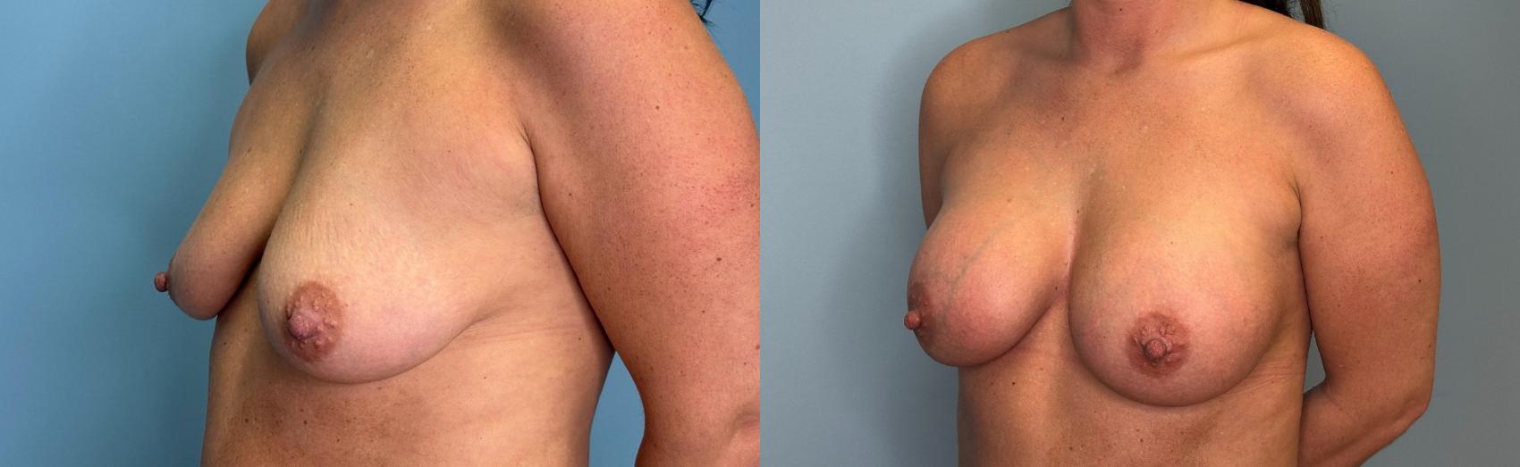 Before & After Mommy Makeover Case 428 Left Side View in Ann Arbor, MI