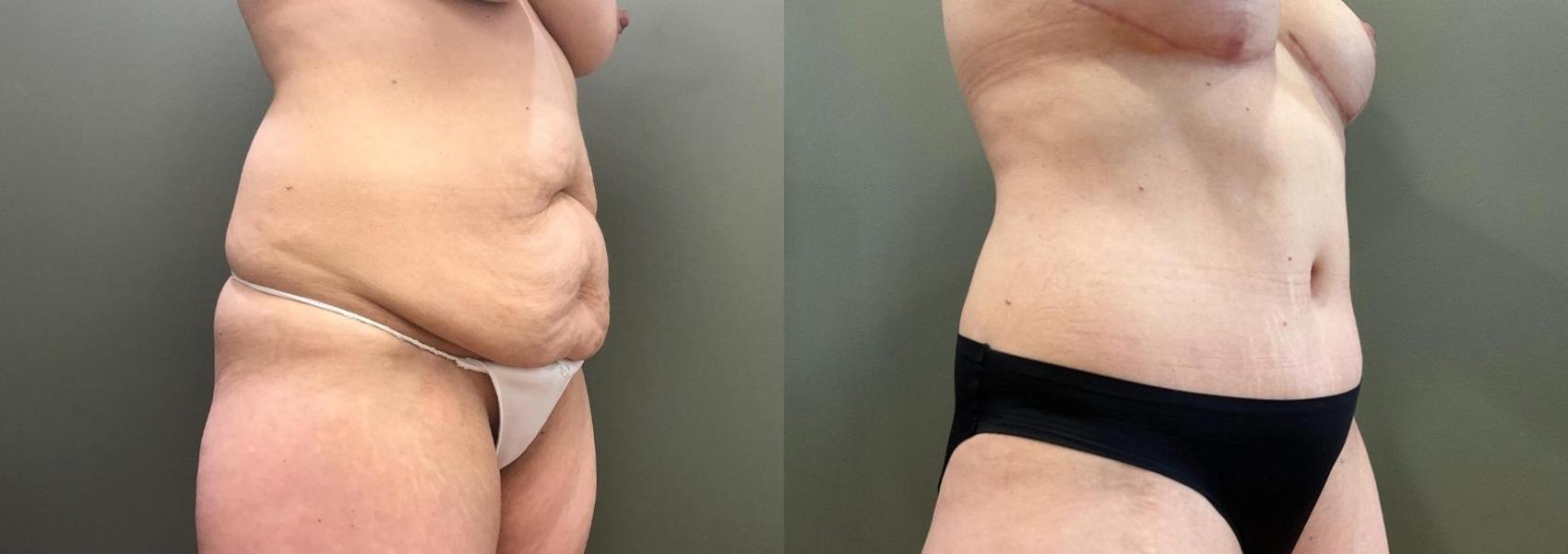 Before & After Mommy Makeover Case 451 Right Oblique View in Ann Arbor, MI