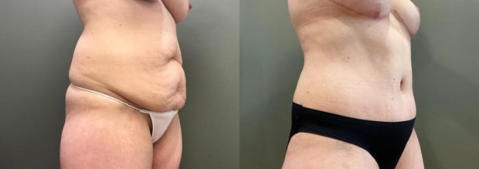 Before & After Mommy Makeover Case 451 Right Oblique View in Ann Arbor, MI