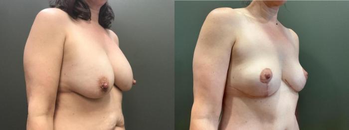 Before & After Mommy Makeover Case 451 Right Side View in Ann Arbor, MI