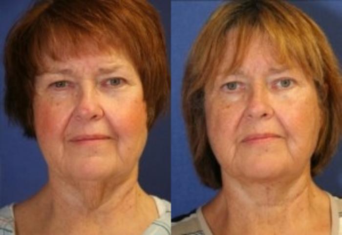 Before & After Neck Lift Case 201 Front View in Ann Arbor, MI