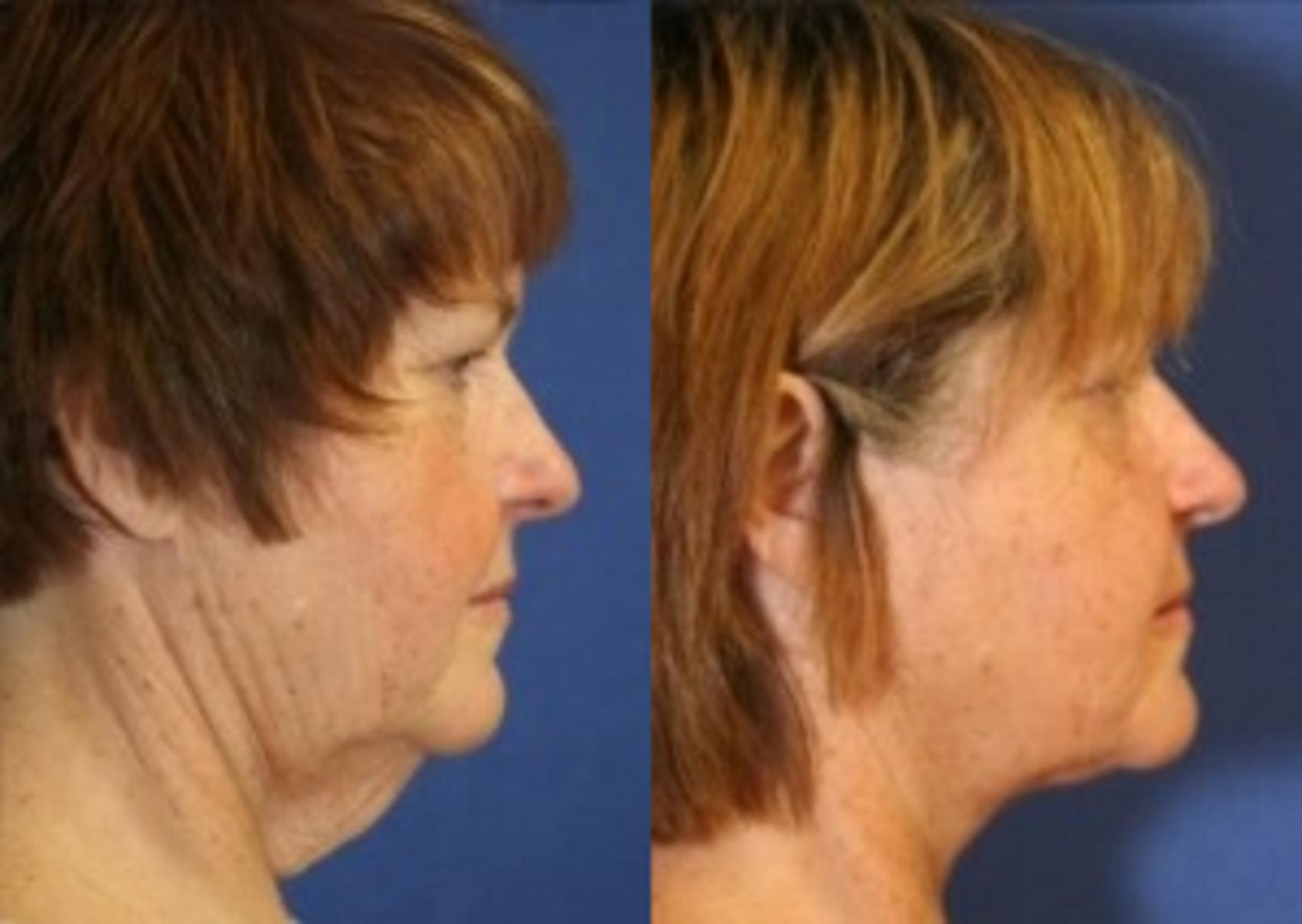Before & After Neck Lift Case 201 Right Side View in Ann Arbor, MI