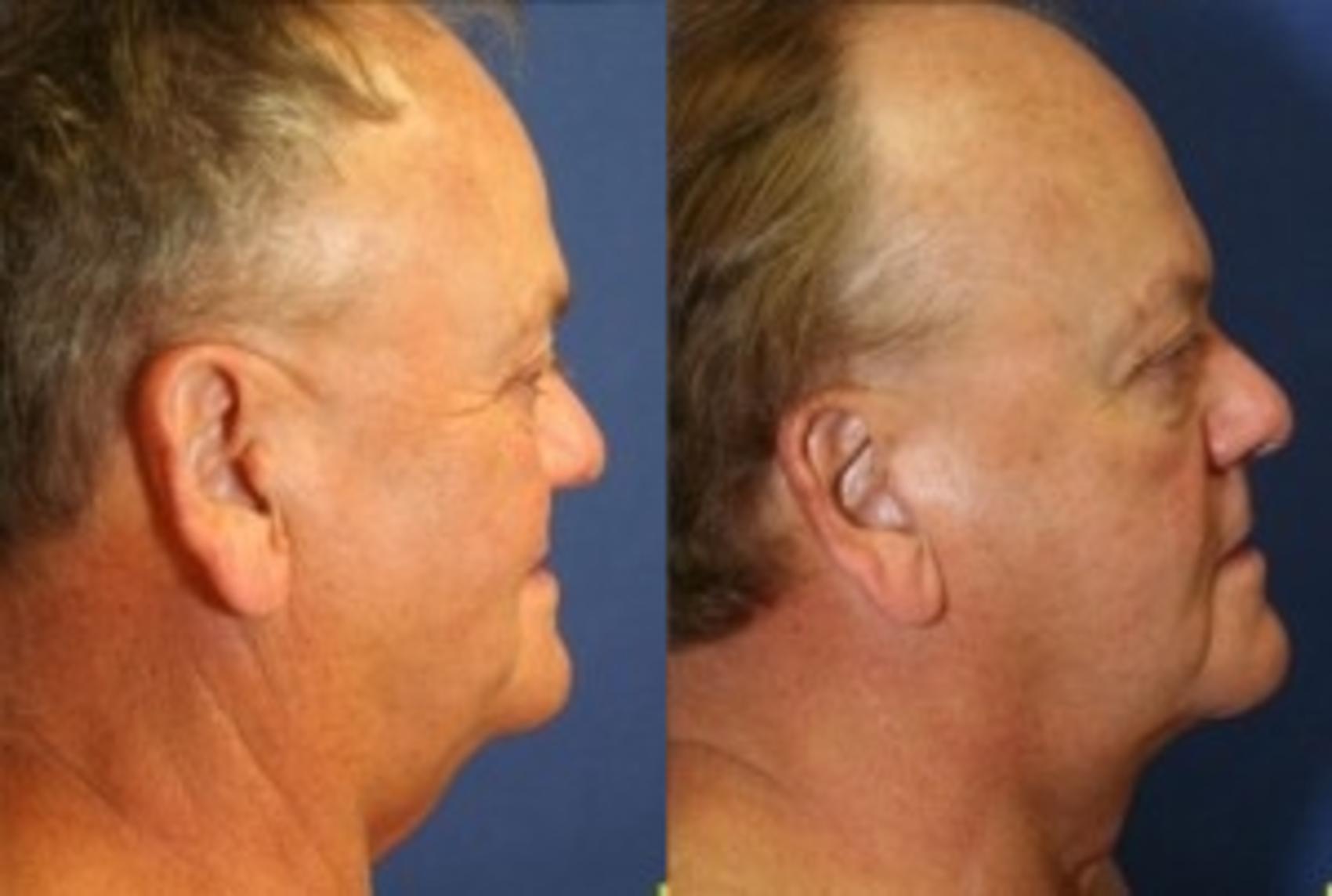 Before & After Neck Lift Case 202 Right Side View in Ann Arbor, MI