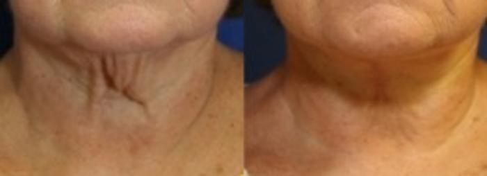 Before & After Neck Lift Case 203 Front View in Ann Arbor, MI