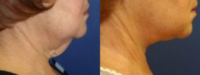 Before & After Neck Lift Case 203 Right Side View in Ann Arbor, MI