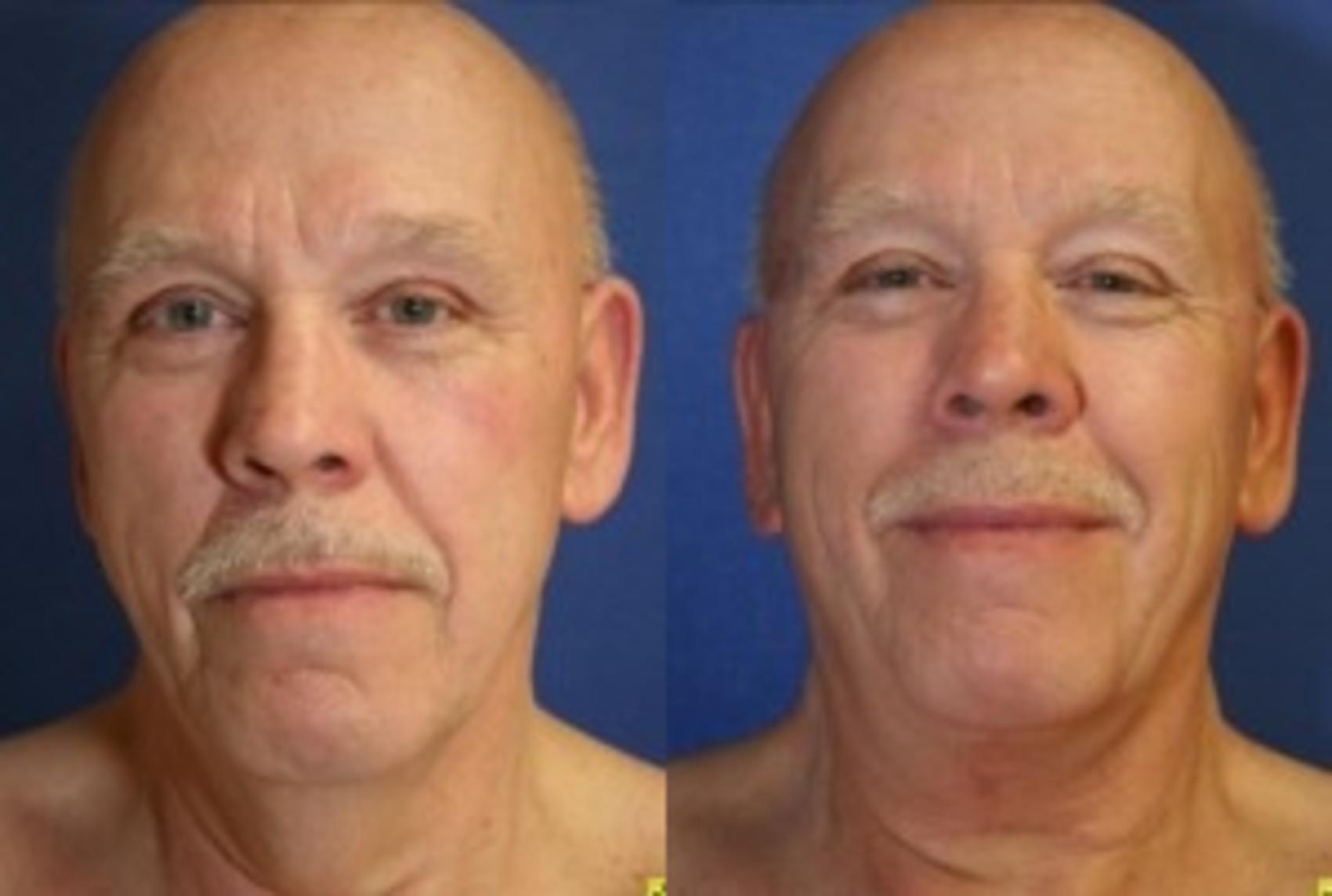 Before & After Neck Lift Case 204 Front View in Ann Arbor, MI