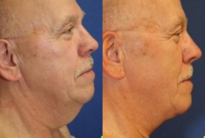 Before & After Neck Lift Case 204 Right Side View in Ypsilanti, MI