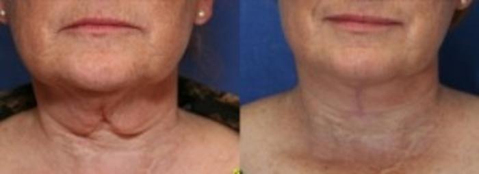 Before & After Neck Lift Case 205 Front View in Ann Arbor, MI