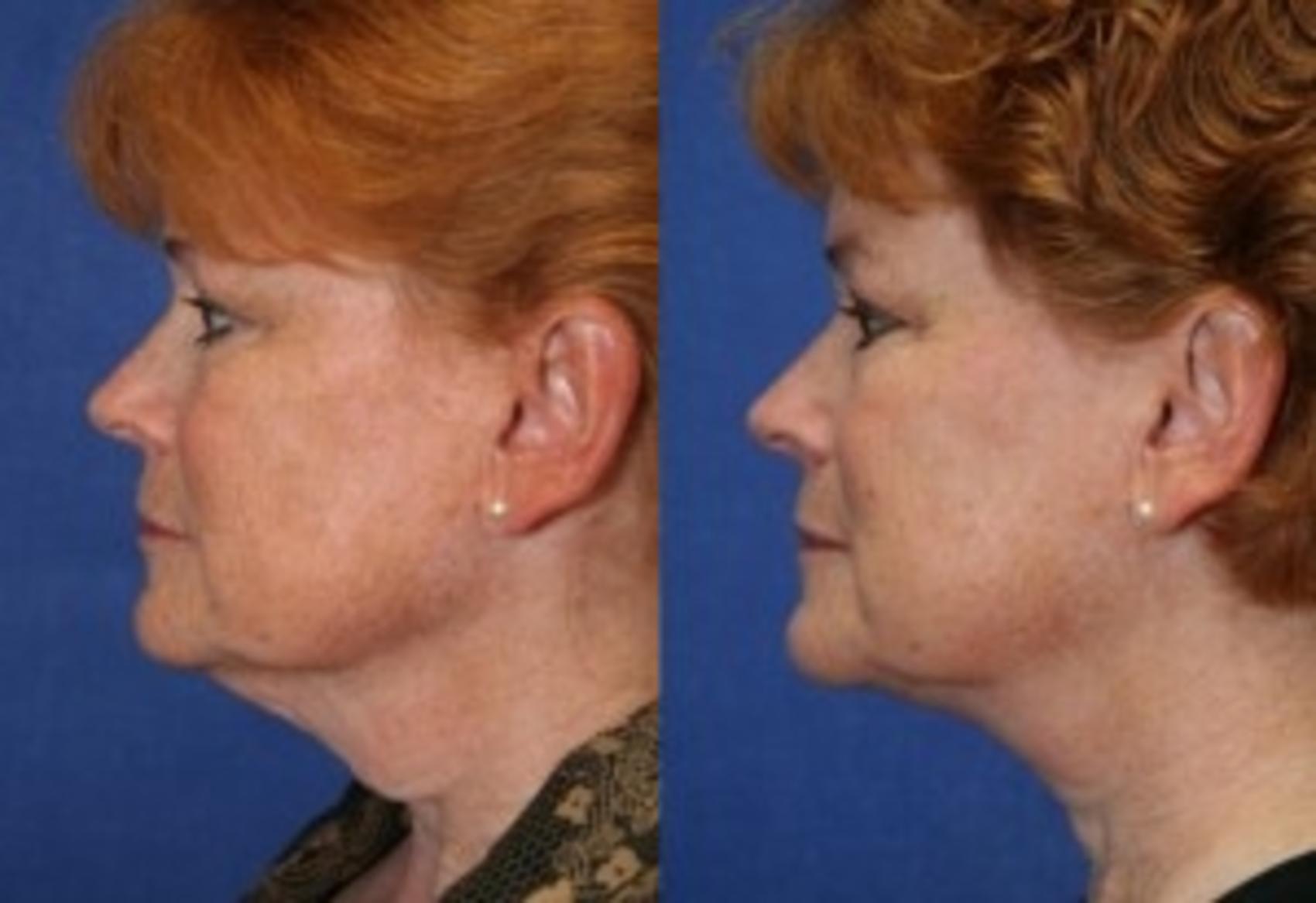 Before & After Neck Lift Case 205 Left Side View in Ann Arbor, MI
