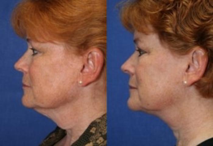 Before & After Neck Lift Case 205 Left Side View in Ann Arbor, MI