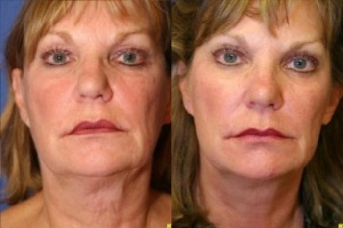 Before & After Neck Lift Case 206 Front View in Ypsilanti, MI