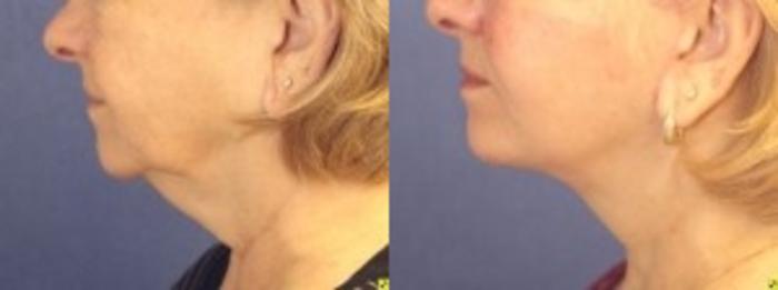 Before & After Neck Lift Case 207 Left Side View in Ann Arbor, MI