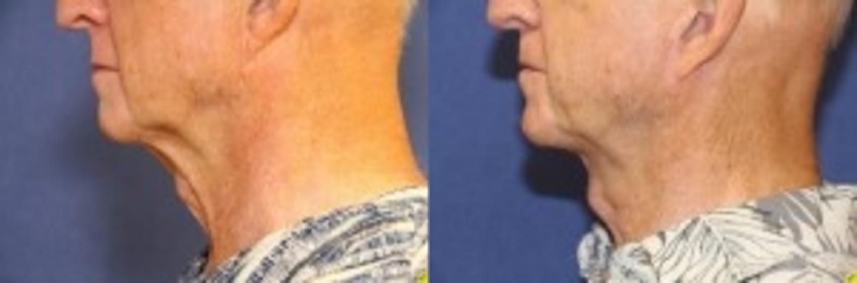 Before & After Neck Lift Case 208 Left Side View in Ann Arbor, MI