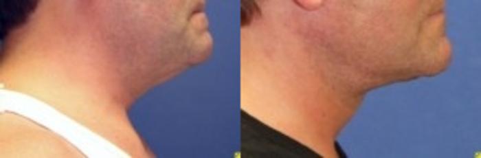 Before & After Neck Lift Case 209 Right Side View in Ann Arbor, MI