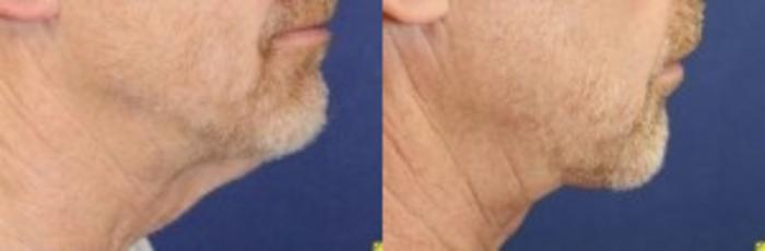 Before & After Neck Lift Case 210 Right Side View in Ann Arbor, MI