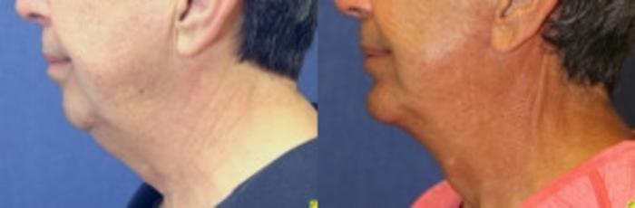 Before & After Neck Lift Case 211 Left Side View in Ann Arbor, MI