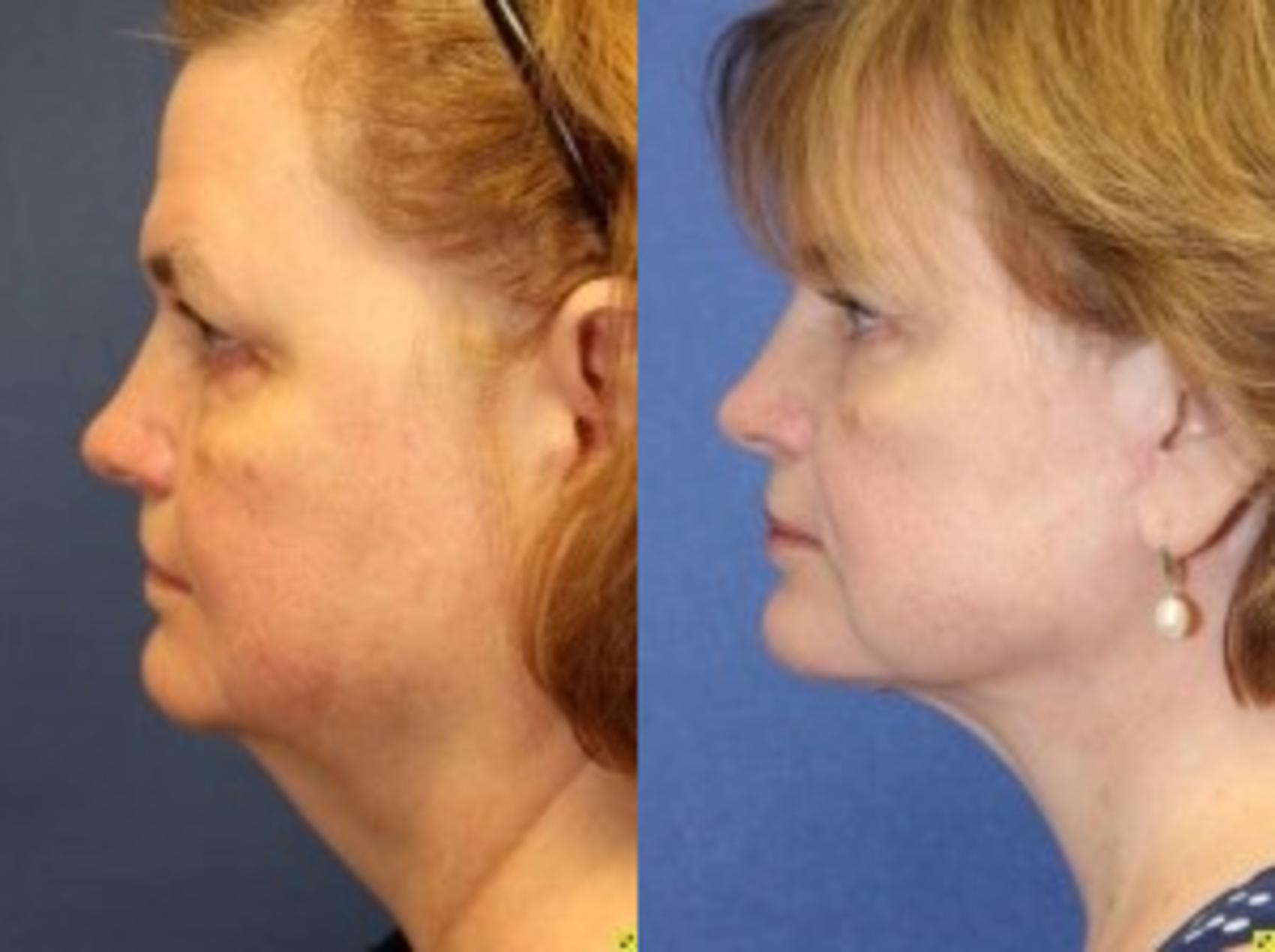 Before & After Neck Lift Case 212 Left Side View in Ann Arbor, MI