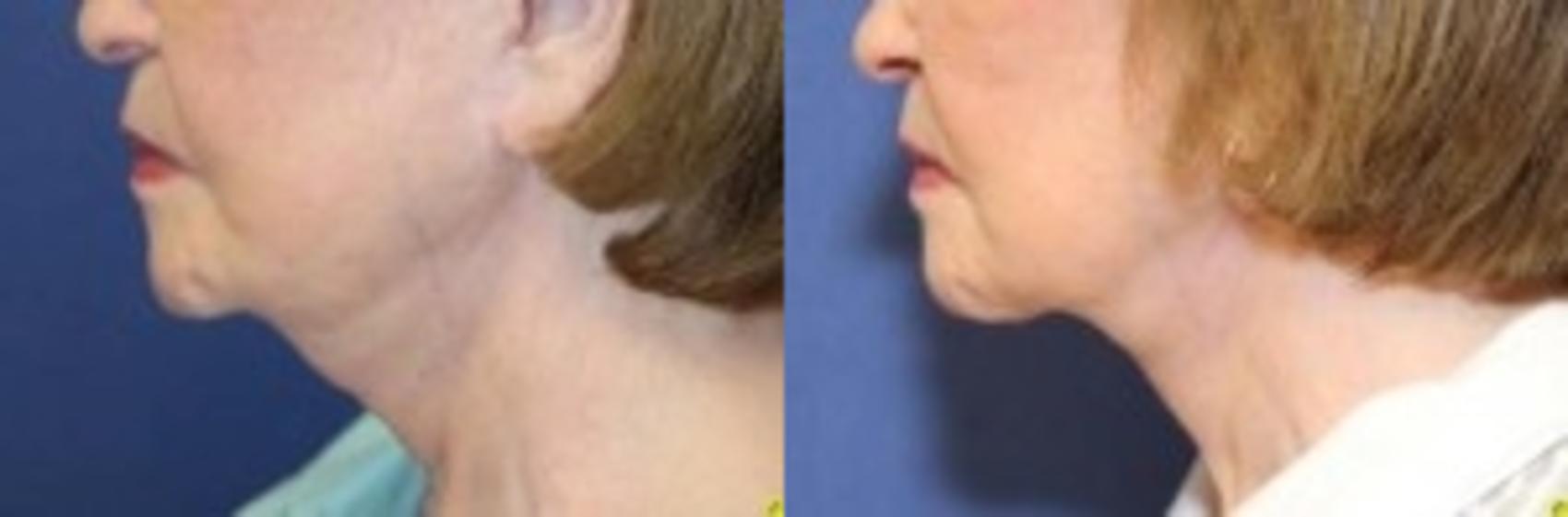 Before & After Neck Lift Case 213 Left Side View in Ann Arbor, MI