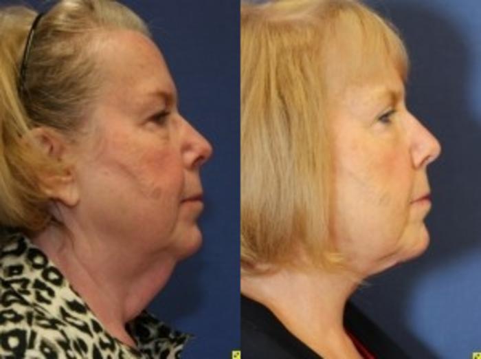 Before & After Neck Lift Case 214 Right Side View in Ann Arbor, MI
