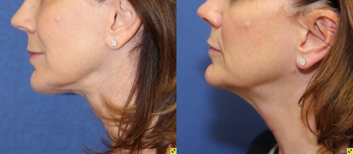 Before & After Neck Lift Case 216 Left Side View in Ann Arbor, MI