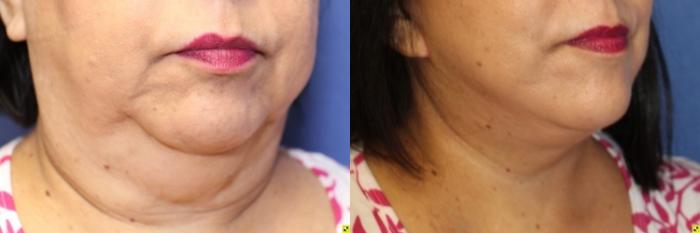 Before & After Neck Lift Case 217 Right Oblique View in Ann Arbor, MI