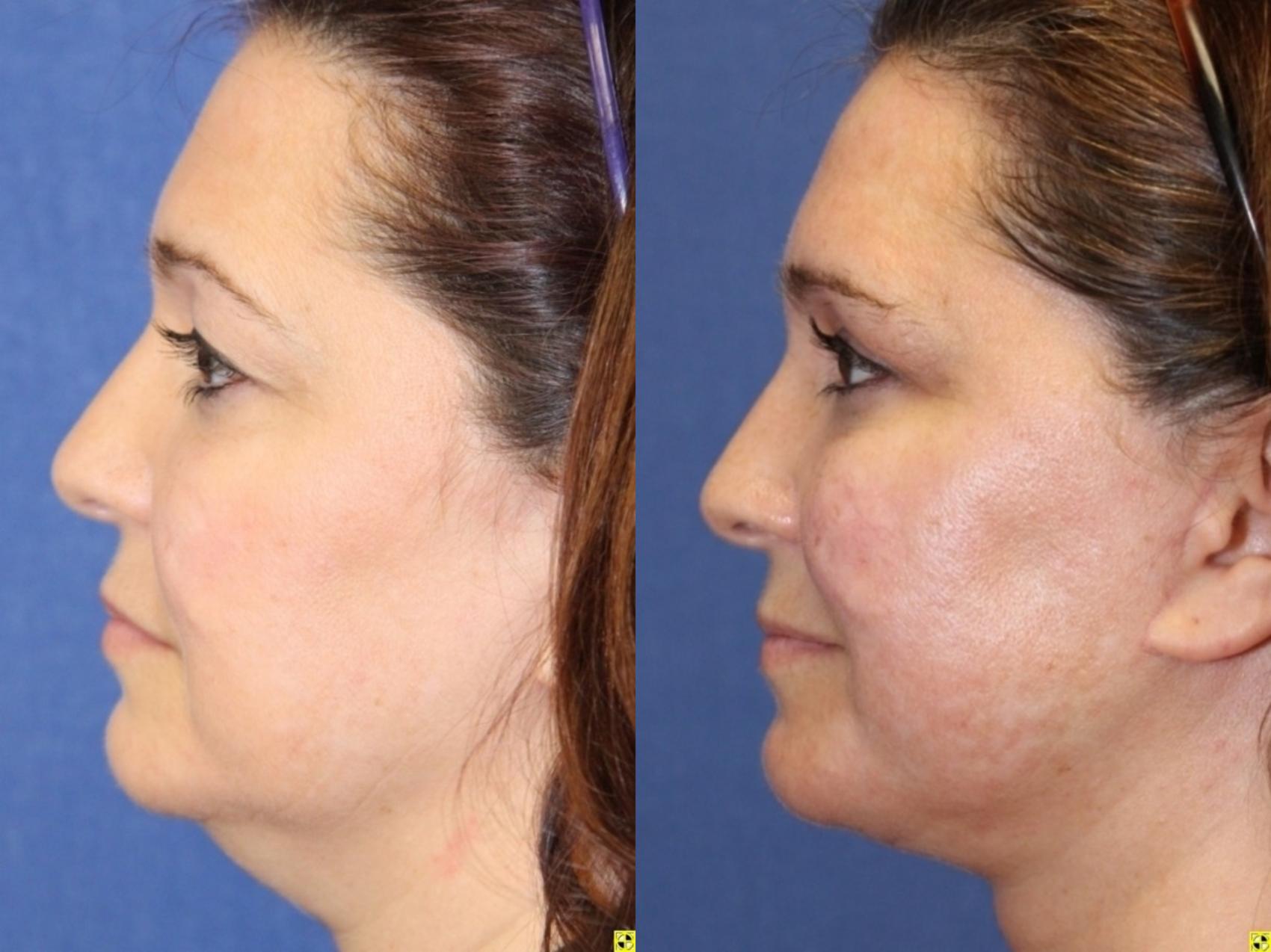 Before & After Neck Lift Case 218 Left Side View in Ann Arbor, MI
