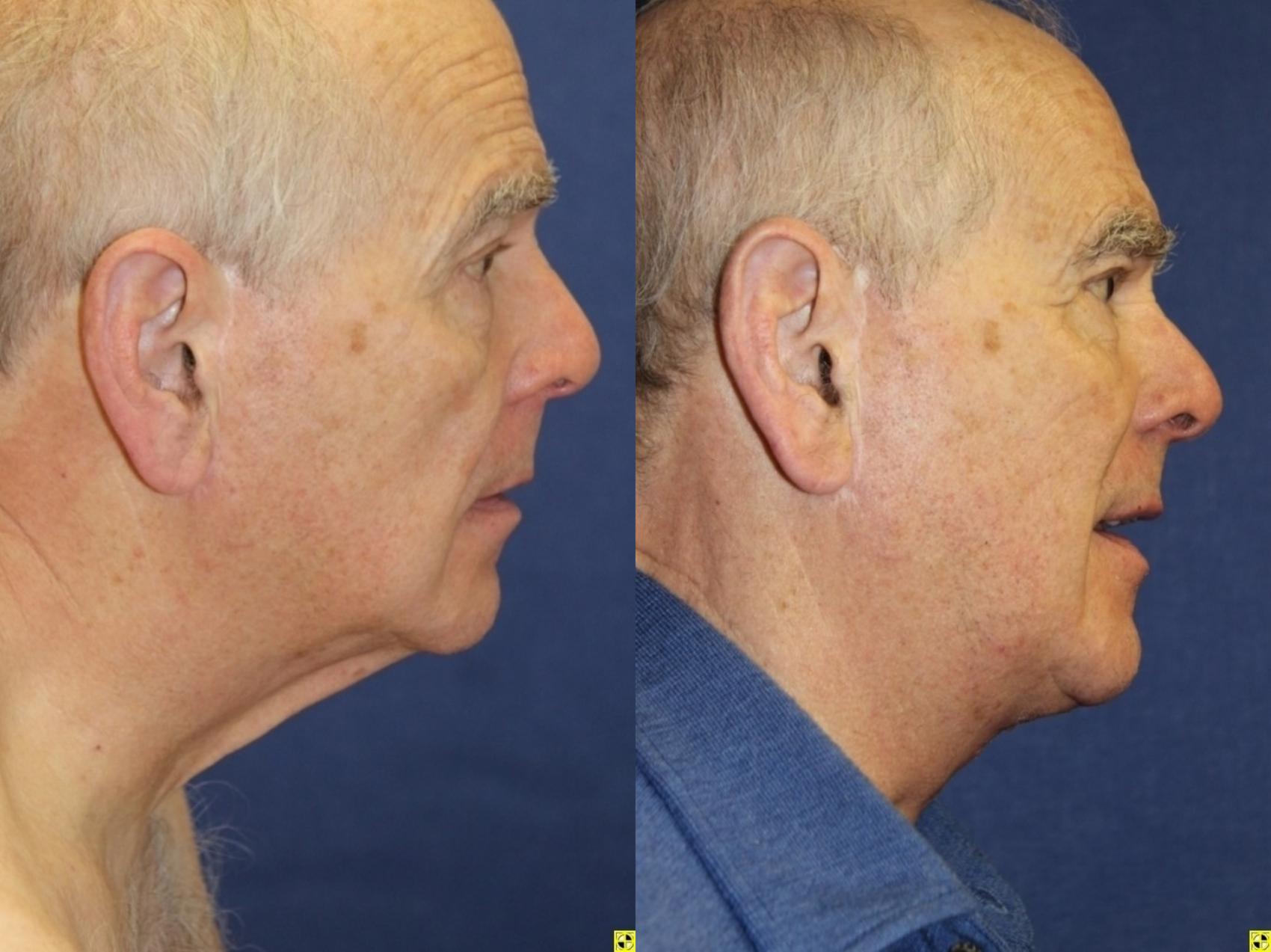 Before & After Neck Lift Case 219 Right Side View in Ann Arbor, MI