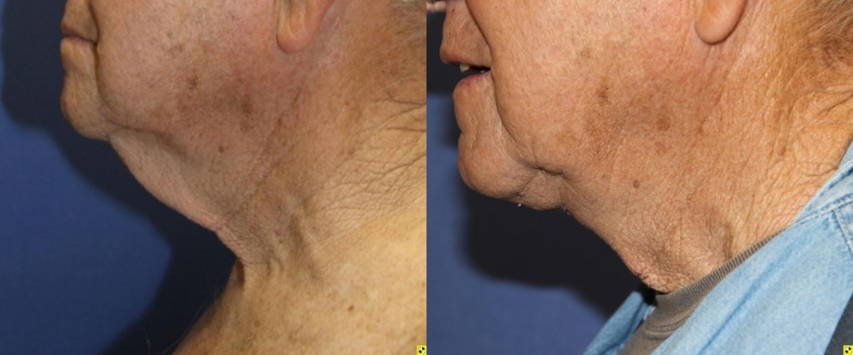 Before & After Neck Lift Case 220 Left Side View in Ann Arbor, MI