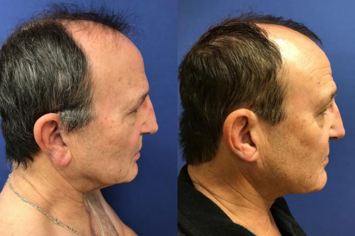 Before & After Neck Lift Case 221 Right Side View in Ann Arbor, MI