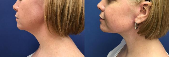 Before & After Neck Lift Case 222 Left Side View in Ann Arbor, MI