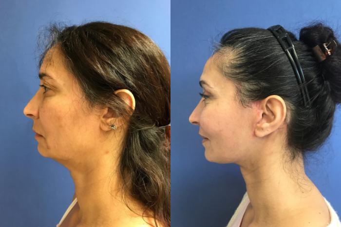 Before & After Neck Lift Case 224 Left Side View in Ann Arbor, MI